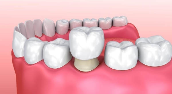 Bọc răng sứ là một phương pháp thẩm mỹ phổ biến